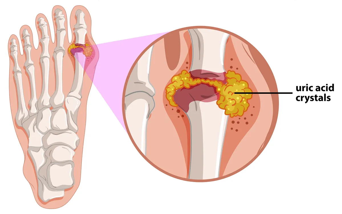 Gout Research Studies