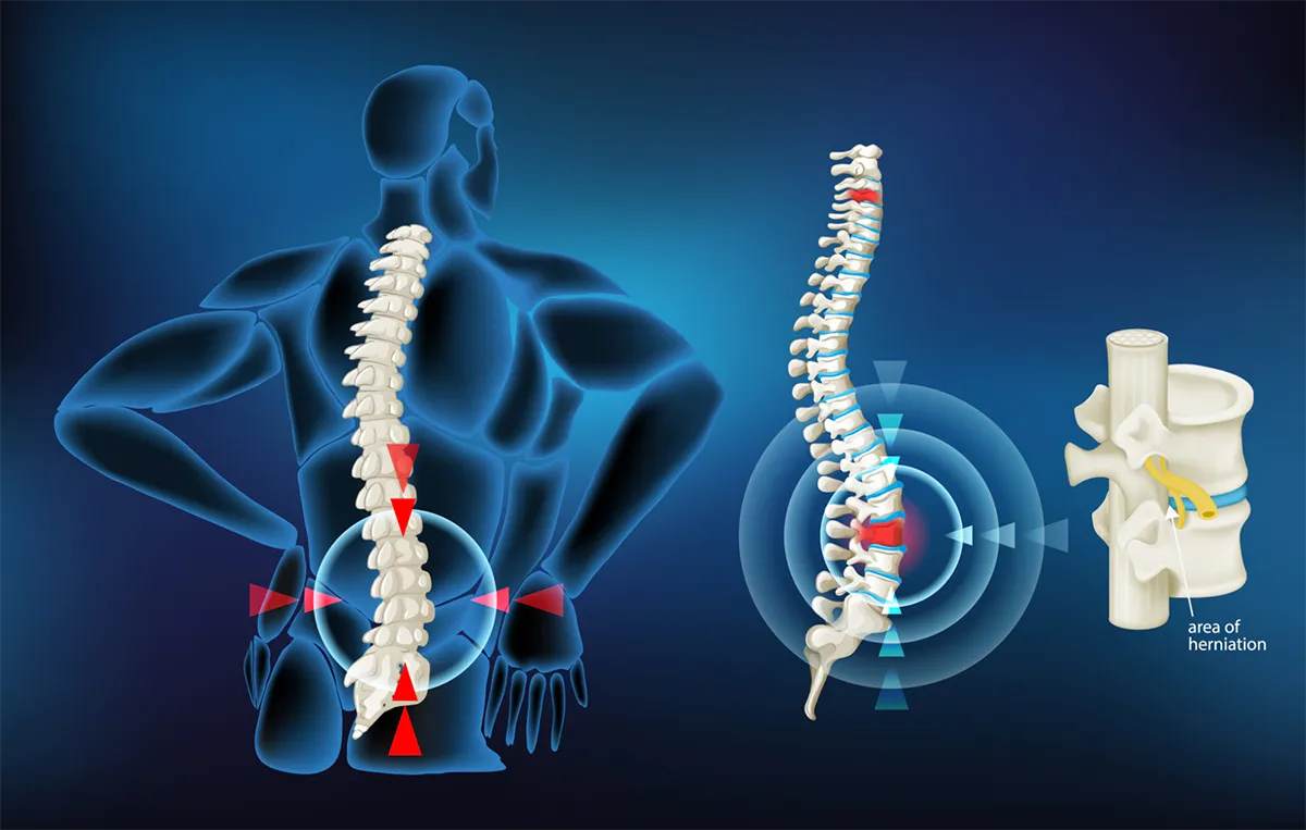 How Should You Sleep If You Have Lower Back Pain? - Atlanta, GA - Spine  Surgery